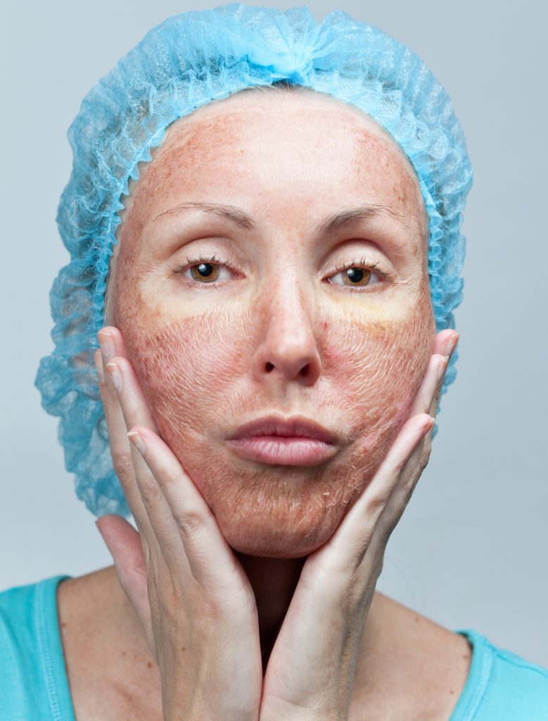 Chemical Peels The Center for Advanced Dermatology Chemical Peels